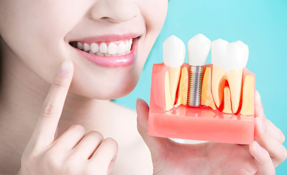 Why Dental Implants Are a Smart Choice for Missing Teeth